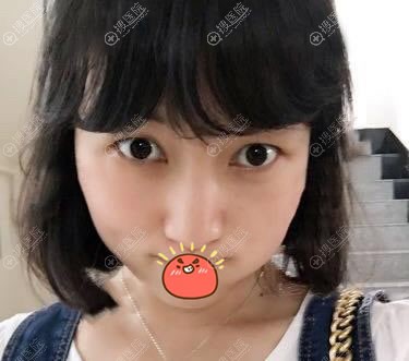 冲着西宁夏都整形好口碑及案例效果找夏碧清医生做了定点双眼皮