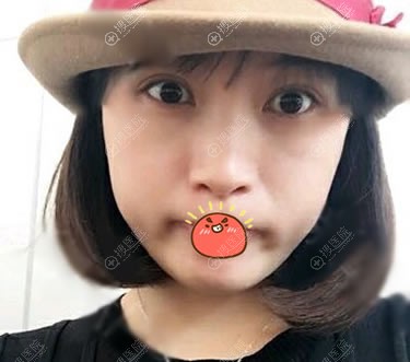 西宁夏都许碧清做双眼皮案例 西宁夏都许碧清做双眼皮案例