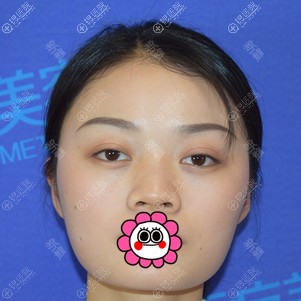 衡阳美莱做肋软骨隆鼻前 衡阳美莱做肋软骨隆鼻前