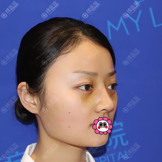 衡阳美莱肋软骨隆鼻7天效果 衡阳美莱肋软骨隆鼻7天效果