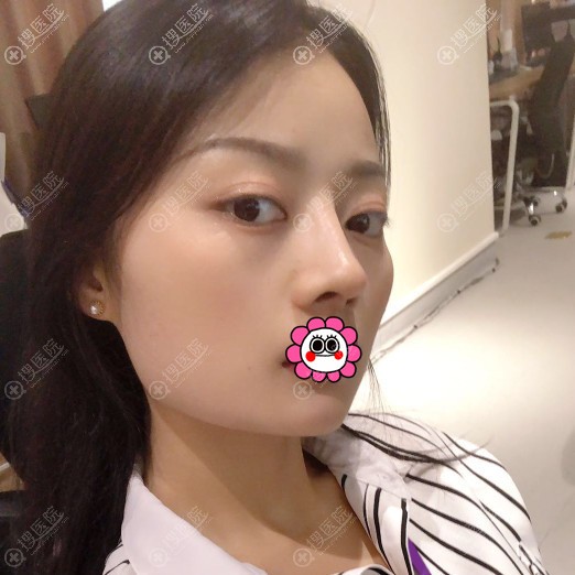 衡阳美莱邓颖肋软骨隆鼻一个月 衡阳美莱邓颖肋软骨隆鼻一个月