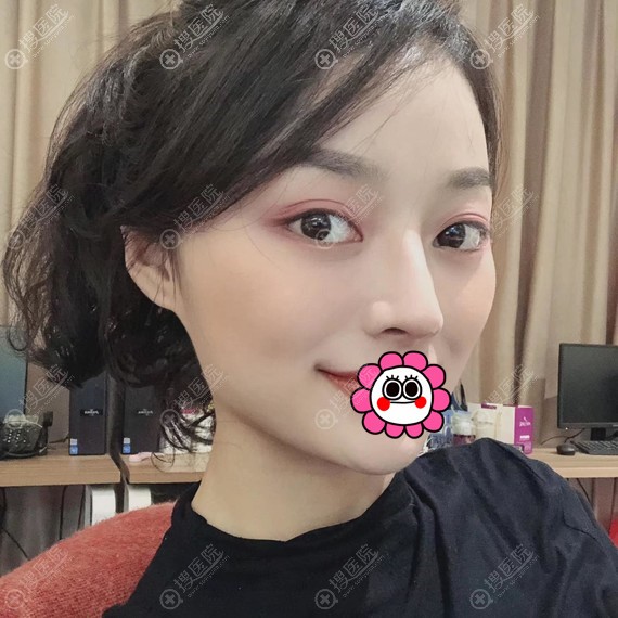 衡阳美莱肋软骨隆鼻案例效果 衡阳美莱肋软骨隆鼻案例效果