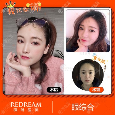 杭州薇琳双眼皮眼综合手术案例 杭州薇琳双眼皮眼综合手术案例