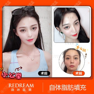 杭州薇琳医美脂肪填充案例 杭州薇琳医美脂肪填充案例