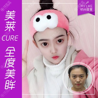 杭州美莱韩超双眼皮眼综合案例 杭州美莱韩超双眼皮眼综合案例