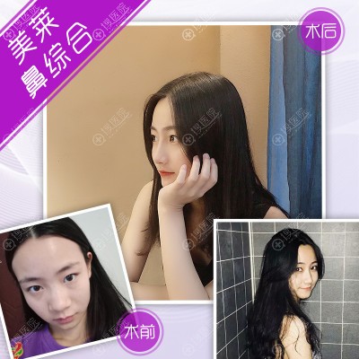 杭州美莱李波隆鼻鼻翼缩小手术案例 杭州美莱李波隆鼻鼻翼缩小手术案例