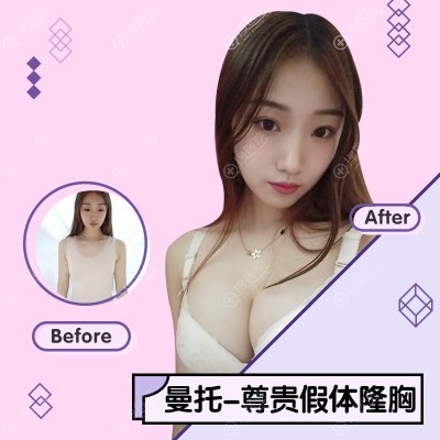 杭州美莱栗勇医生隆胸案例 杭州美莱栗勇医生隆胸案例