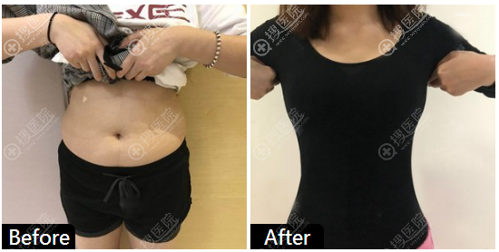 杭州美莱翟爽腰腹部吸脂案例 杭州美莱翟爽腰腹部吸脂案例