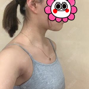 我找杭州薇琳熊丽大腿吸脂+脂肪丰胸后恢复一个月案例效果