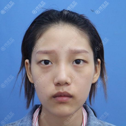 杭州割双眼皮哪个医生好?请看杭州格莱美王馨婉做的双眼皮案例