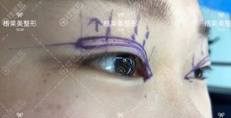 且不论益阳格莱美整形价格贵不贵,先看袁亮飞给我做双眼皮效果