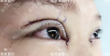 益阳格莱美全切双眼皮案例即刻效果 益阳格莱美全切双眼皮案例即刻效果