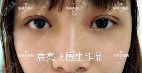 益阳格莱美整形袁亮飞双眼皮案例 益阳格莱美整形袁亮飞双眼皮案例