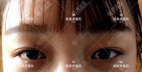 益阳格莱美做双眼皮效果怎么样 益阳格莱美做双眼皮效果怎么样