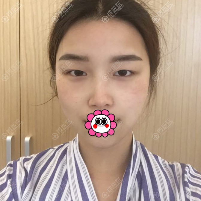 连云港华美双眼皮手术前 连云港华美双眼皮手术前