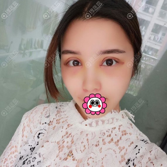 连云港华美做双眼皮恢复三天 连云港华美做双眼皮恢复三天