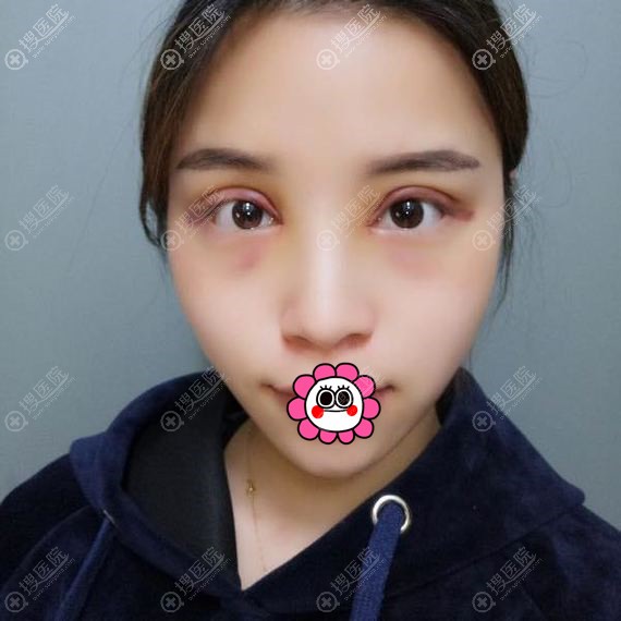 连云港华美双眼皮七天拆线后效果 连云港华美双眼皮七天拆线后效果