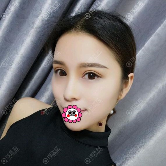 连云港华美双眼皮效果怎么样? 连云港华美双眼皮效果怎么样?
