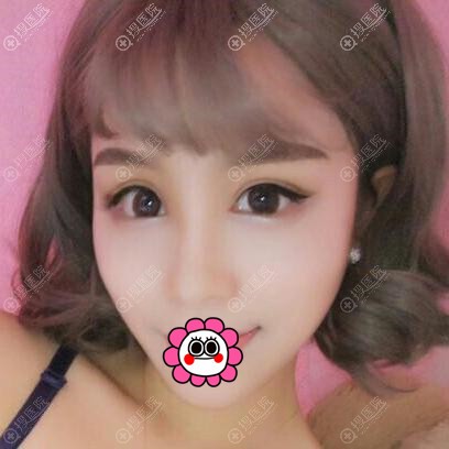 连云港华美孙振东双眼皮恢复一个月效果 连云港华美孙振东双眼皮恢复一个月效果