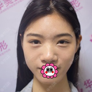 分享我找连云港华美孙振东的手术经历:达拉斯隆鼻和隆下巴