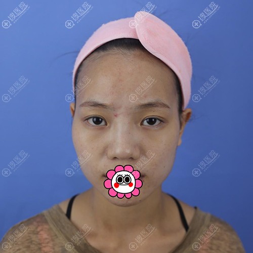 福州涣美乐凤亮做的鼻综合效果好不好?从我恢复经历和价格了解