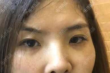 术前眼睛内双眼睛看起来小 术前眼睛内双眼睛看起来小