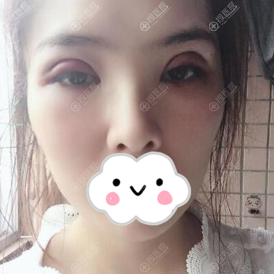 深圳米兰柏羽黎慧娟双眼皮术后即刻 深圳米兰柏羽黎慧娟双眼皮术后即刻