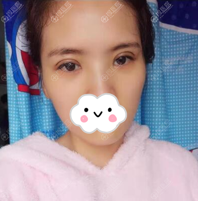 切开双眼皮术后7天恢复照片 切开双眼皮术后7天恢复照片