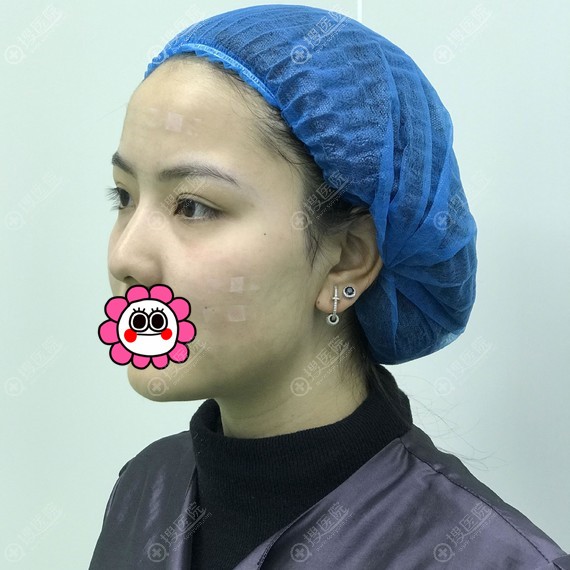 ����֬���沿��伴��Ч��