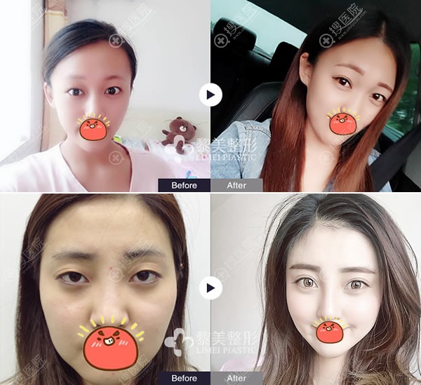 新疆黎美许黎割双眼皮开眼角案例 新疆黎美许黎割双眼皮开眼角案例