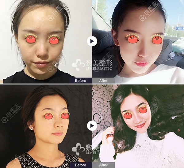 <!--<i data=20240710 data-id=12320></i>-->张春亮隆鼻案例 <!--<i data=20240710 data-id=12320></i>-->张春亮隆鼻案例