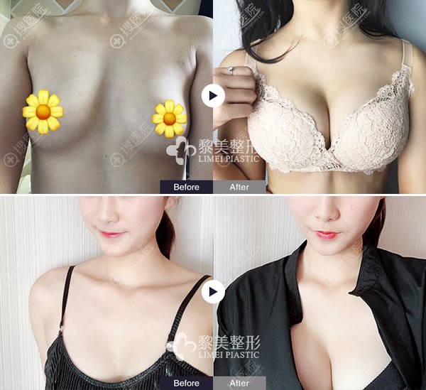 乌鲁木齐天山区黎美许黎隆胸案例 乌鲁木齐天山区黎美许黎隆胸案例