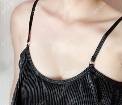 在新疆乌鲁木齐黎美整形做了吸脂和隆胸手术,给大家展示一下