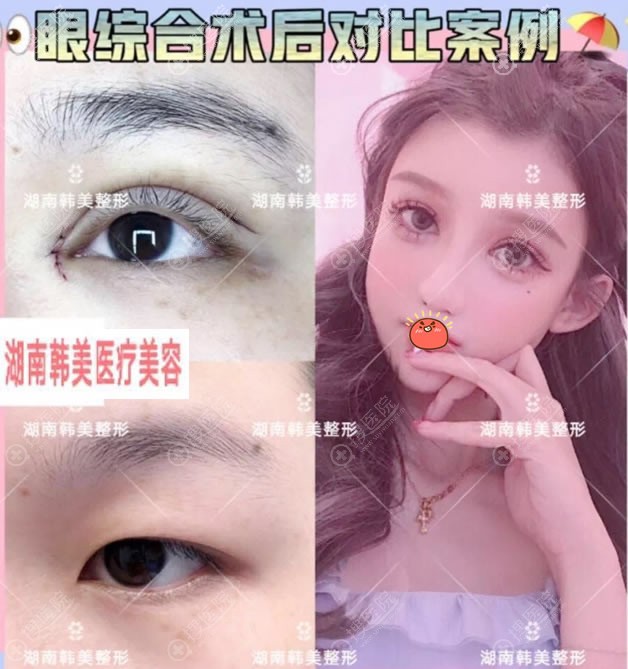 湖南韩美整形<!--<i data=20240710 data-id=16720></i>-->双眼皮案例 湖南韩美整形<!--<i data=20240710 data-id=16720></i>-->双眼皮案例