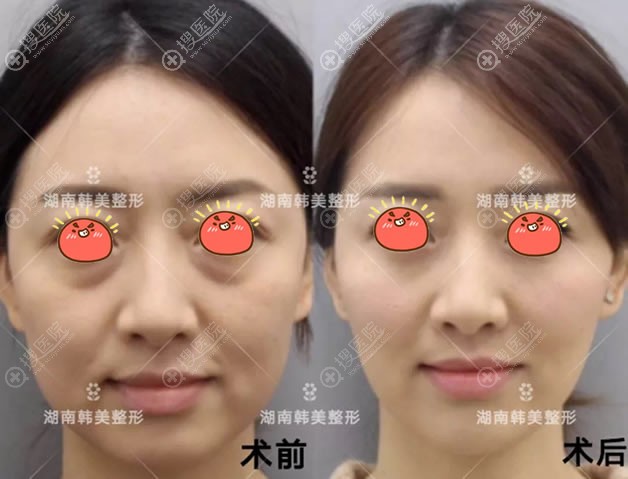 <!--<i data=20240710 data-id=10650></i>-->刘华荣面部线雕案例 <!--<i data=20240710 data-id=10650></i>-->刘华荣面部线雕案例