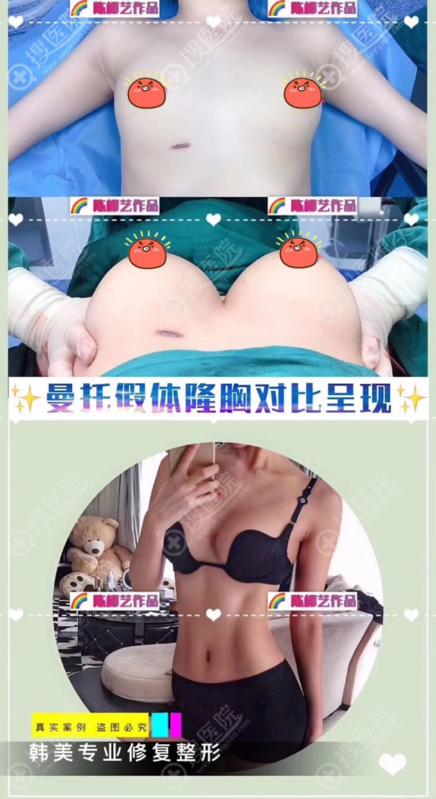 湖南韩美<!--<i data=20240710 data-id=17396></i>-->曼托假体隆胸案例 湖南韩美<!--<i data=20240710 data-id=17396></i>-->曼托假体隆胸案例