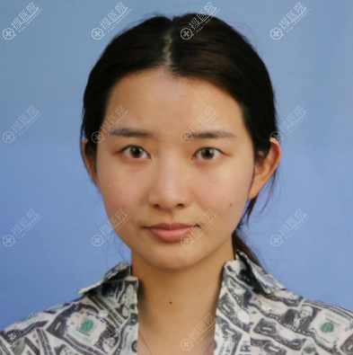 去温州yestar面诊完感觉挺正规靠谱的就找谭立文做了双眼皮隆鼻