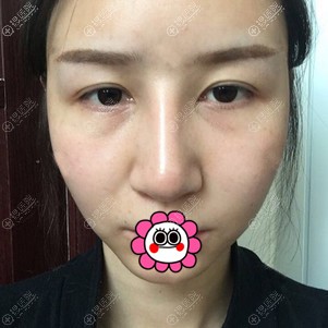 孝感天妃做眼综合鼻综合前 孝感天妃做眼综合鼻综合前