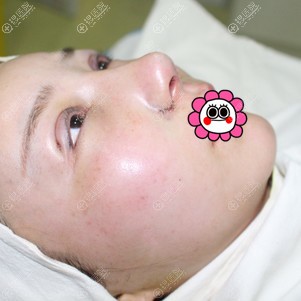 孝感天妃做完眼鼻综合手术后即刻效果 孝感天妃做完眼鼻综合手术后即刻效果