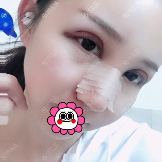 孝感天妃眼鼻综合术后2天 孝感天妃眼鼻综合术后2天