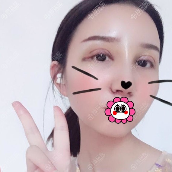 孝感天妃做眼鼻综合术后4天效果 孝感天妃做眼鼻综合术后4天效果