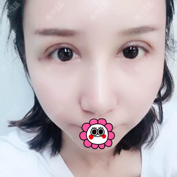 孝感天妃柳肖眼鼻综合术后7天恢复效果 孝感天妃柳肖眼鼻综合术后7天恢复效果