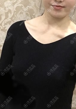 <!--<i data=20240710 data-id=8260></i>-->做自体脂肪丰胸术后 <!--<i data=20240710 data-id=8260></i>-->做自体脂肪丰胸术后