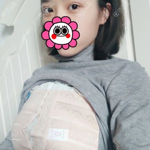 昆明艺星假体隆胸术后三天 昆明艺星假体隆胸术后三天