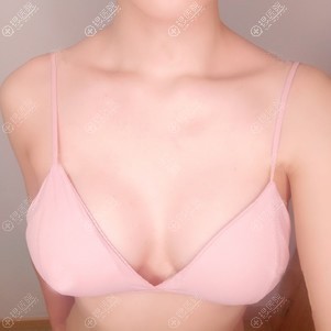 假体隆胸恢复一个月案例 假体隆胸恢复一个月案例