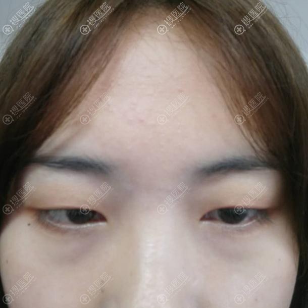 到<!--<i data=20240710 data-id=11915></i>-->做双眼皮前 到<!--<i data=20240710 data-id=11915></i>-->做双眼皮前