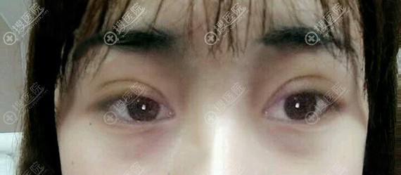 <!--<i data=20240710 data-id=11915></i>-->双眼皮术后7天拆线后效果 <!--<i data=20240710 data-id=11915></i>-->双眼皮术后7天拆线后效果