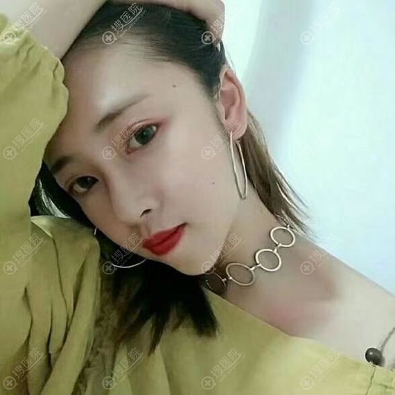 <!--<i data=20240710 data-id=11915></i>-->双眼皮术后20天 <!--<i data=20240710 data-id=11915></i>-->双眼皮术后20天