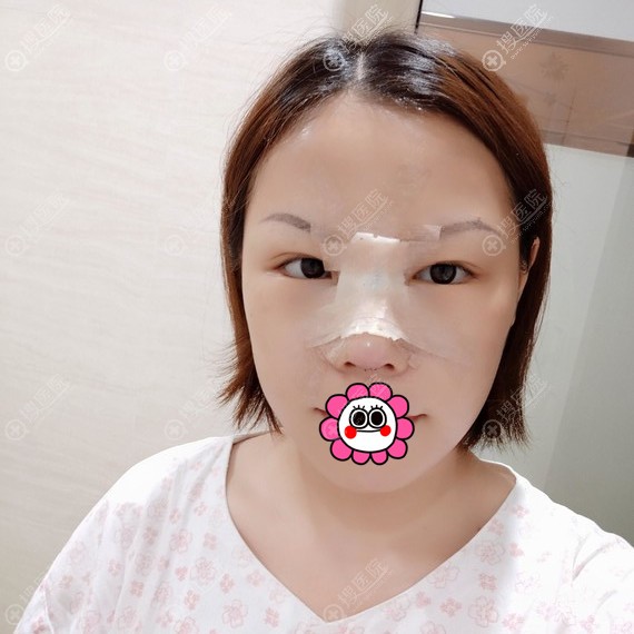 肋软骨隆鼻术后恢复三天效果 肋软骨隆鼻术后恢复三天效果