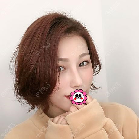 佛山曙光金子肋软骨隆鼻一个月恢复效果 佛山曙光金子肋软骨隆鼻一个月恢复效果